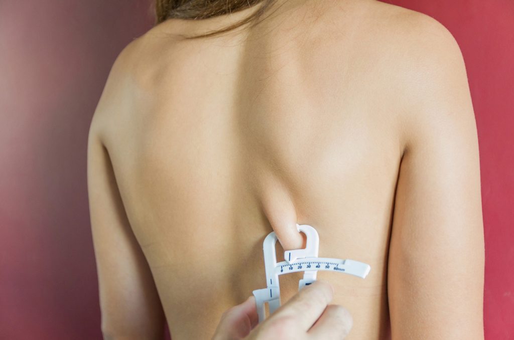 Close-up of skinfold caliper measurement on back by professional weight loss doctor in Houston, assessing body fat for customized fitness and nutrition guidance.